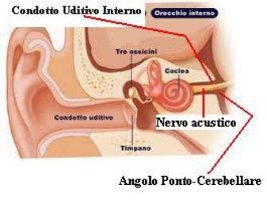 Neurinoma Dell Acustico Tumore Benigno Sintomi Associati Ipoacusia